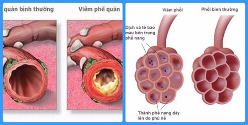 Bật mí những điều bạn chưa biết về viêm phế quản bội nhiễm